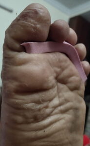 Foot-pompholyx-1