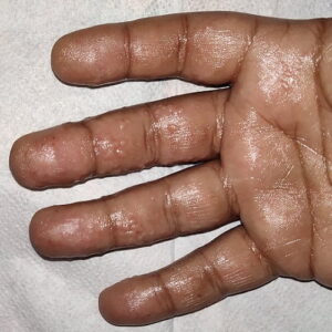 Hand-pompholyx-1