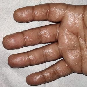 Itchy Heat Bumps