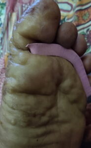 foot-Heat-bumps-1