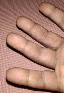 hand-heat-bumps-1